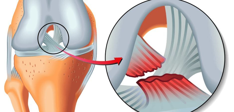 articulation du genou blessée