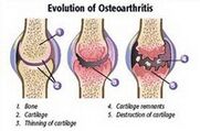 Étapes de l'arthrose