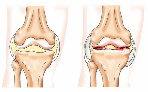 Articulation saine et arthrose