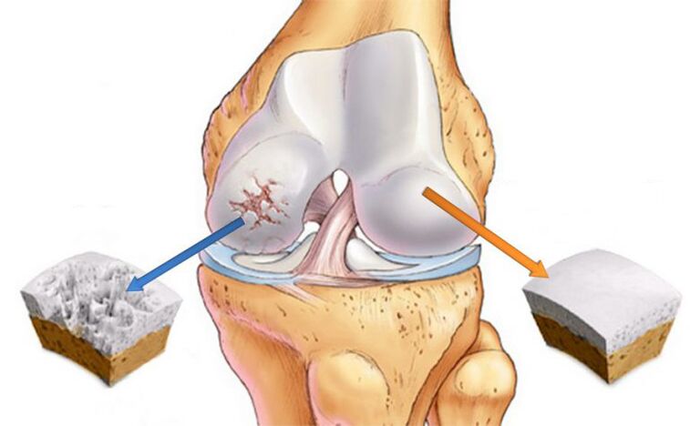 arthrose déformant