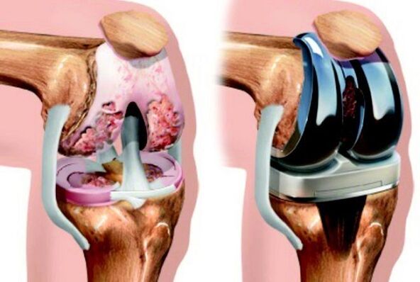 avant et après arthrose de l'articulation du genou pour arthrose