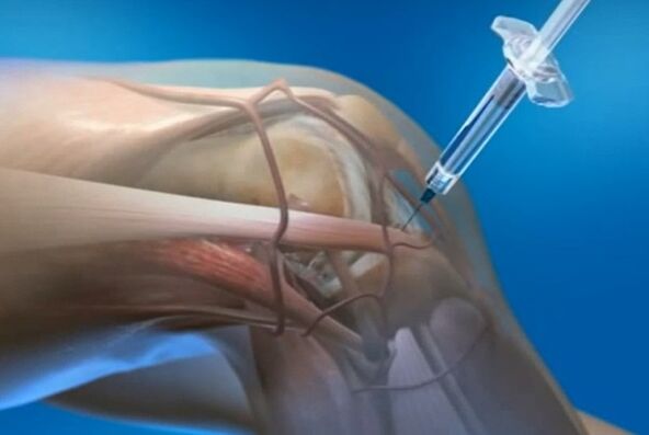 injections intra-articulaires pour arthrose de l'articulation du genou